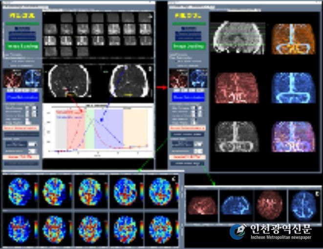 혈관재개통 환자 선별 S/W